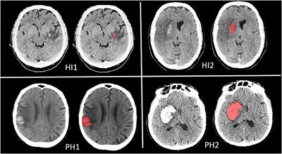 Added Prognostic Value of Hemorrhagic Transformation Quantification in Patients With Acute Ischemic Stroke